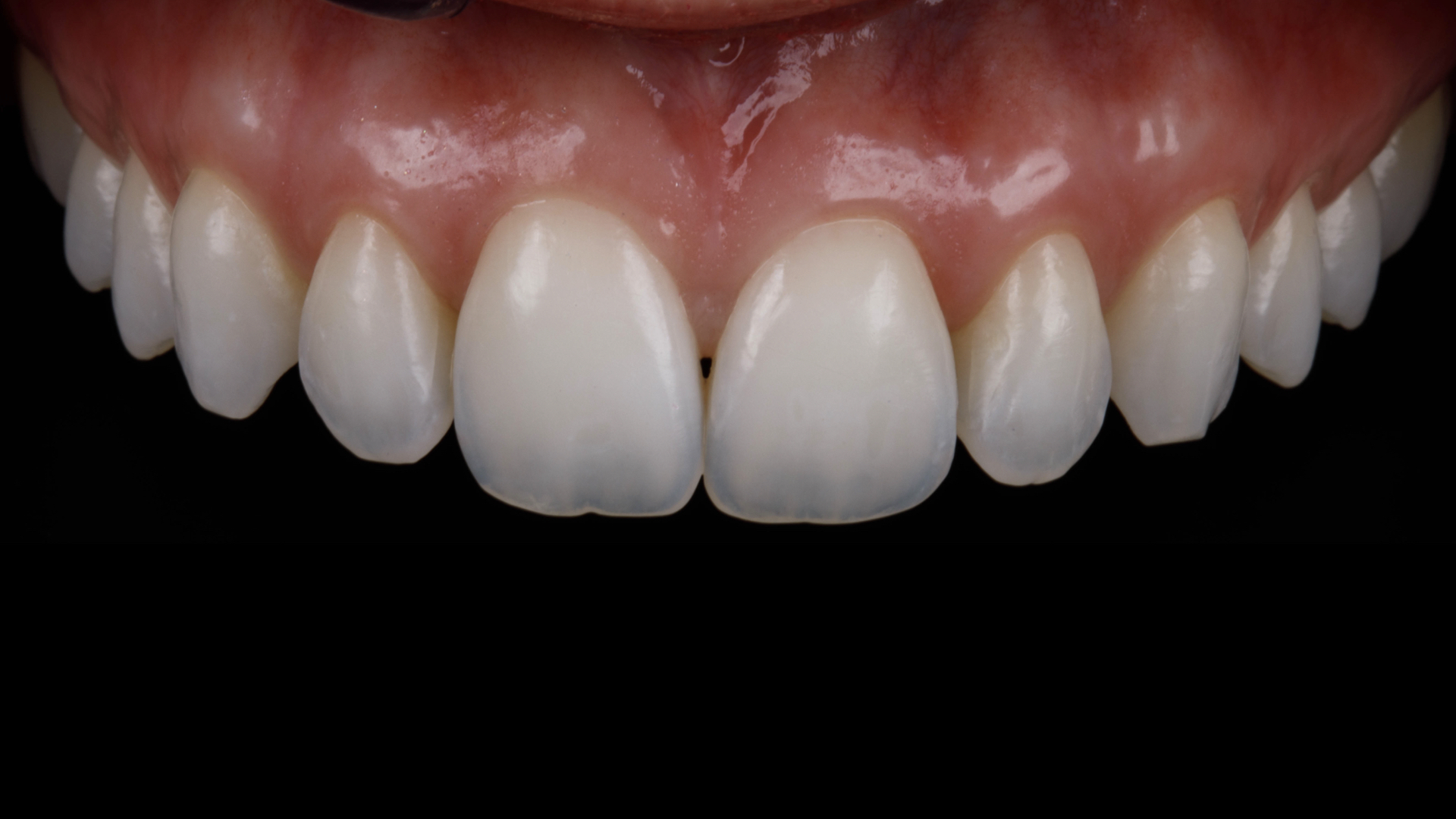 Fotografía de los dientes anteriores con fondo negro