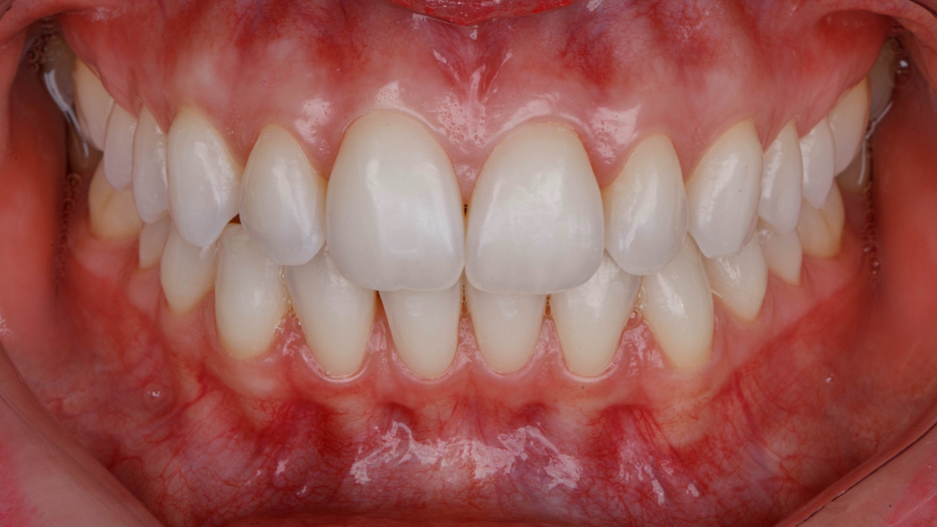 Fotografía intraoral frontal