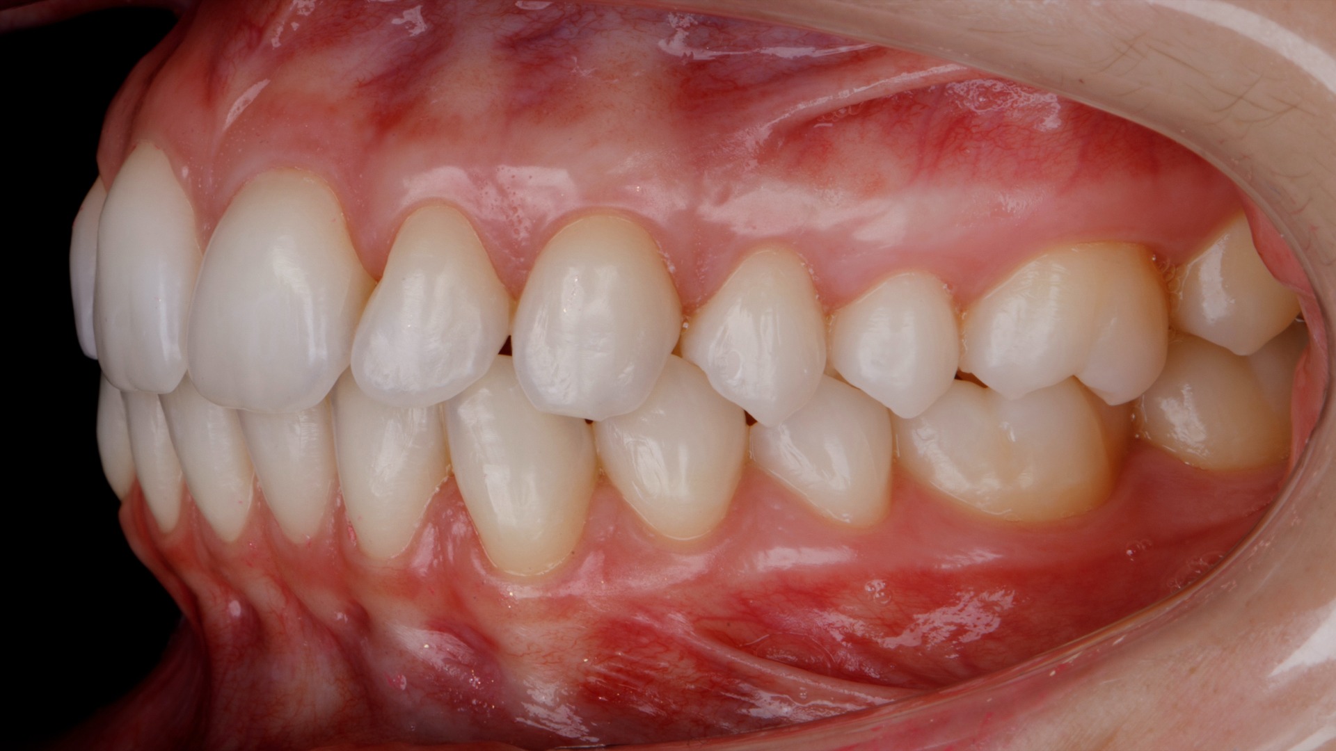 Fotografía intraoral lateral