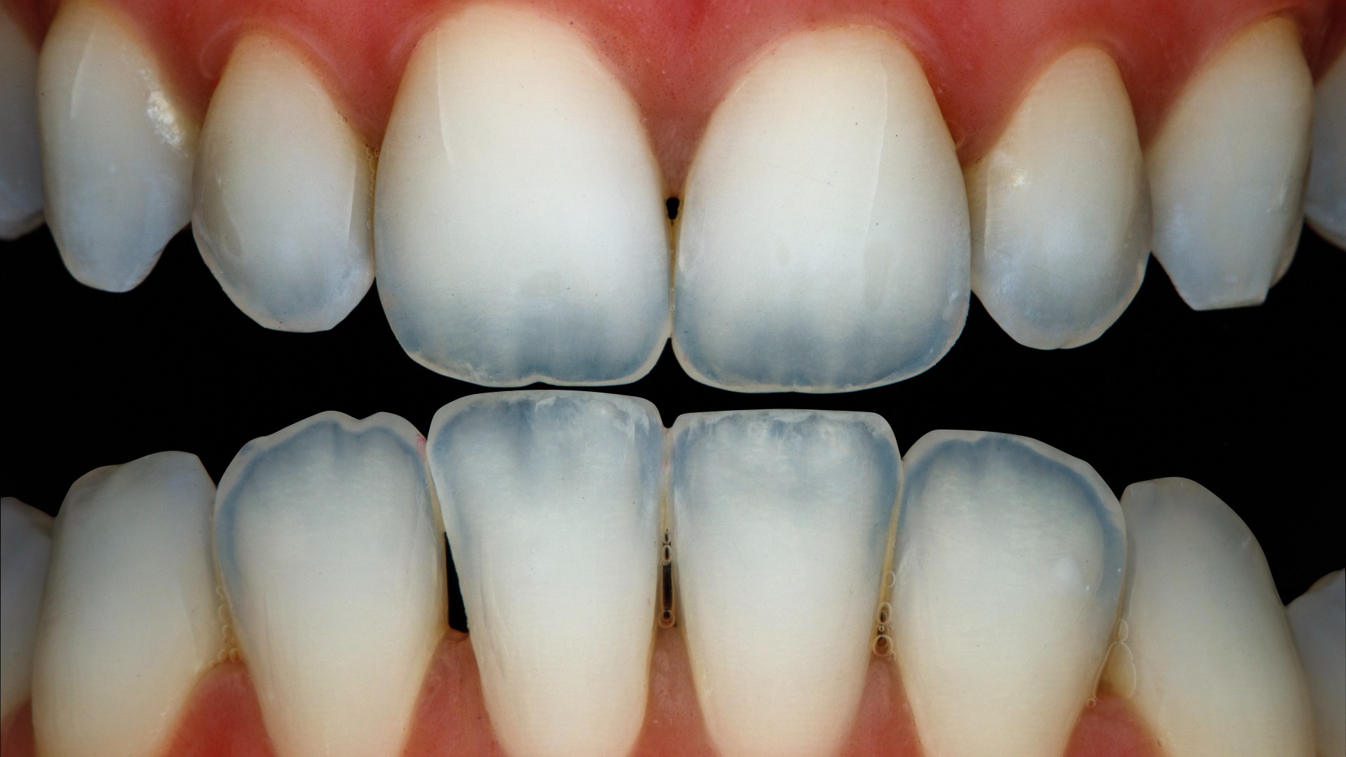 Fotografía polarizada de los dientes anteriores