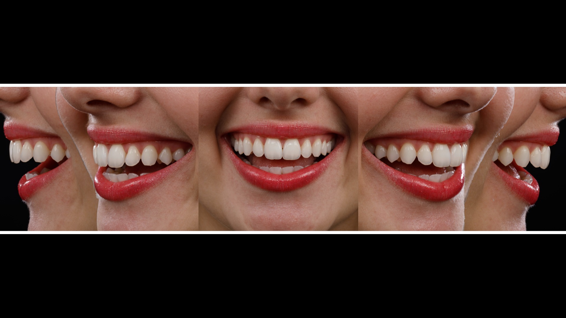 Secuencia de diferentes ángulos de la sonrisa en el protocolo fotográfico facial